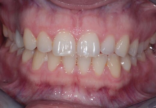 До лікування