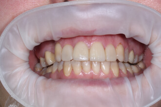Художня реставрація зубів 1