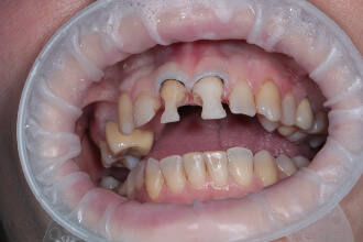 Художня реставрація зубів 2