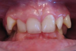 children's orthodontics case 1 picture 1