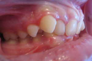 children's orthodontics case 1 picture 2