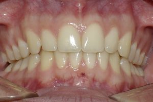 children's orthodontics case 1 picture 3