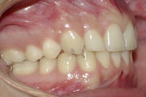 children's orthodontics case 1 picture 4