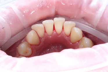 Tartar Removal case 1 picture 4