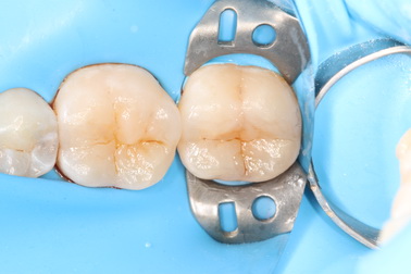 Dental filling case 1 picture 3