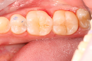 Dental filling case 1 picture 4